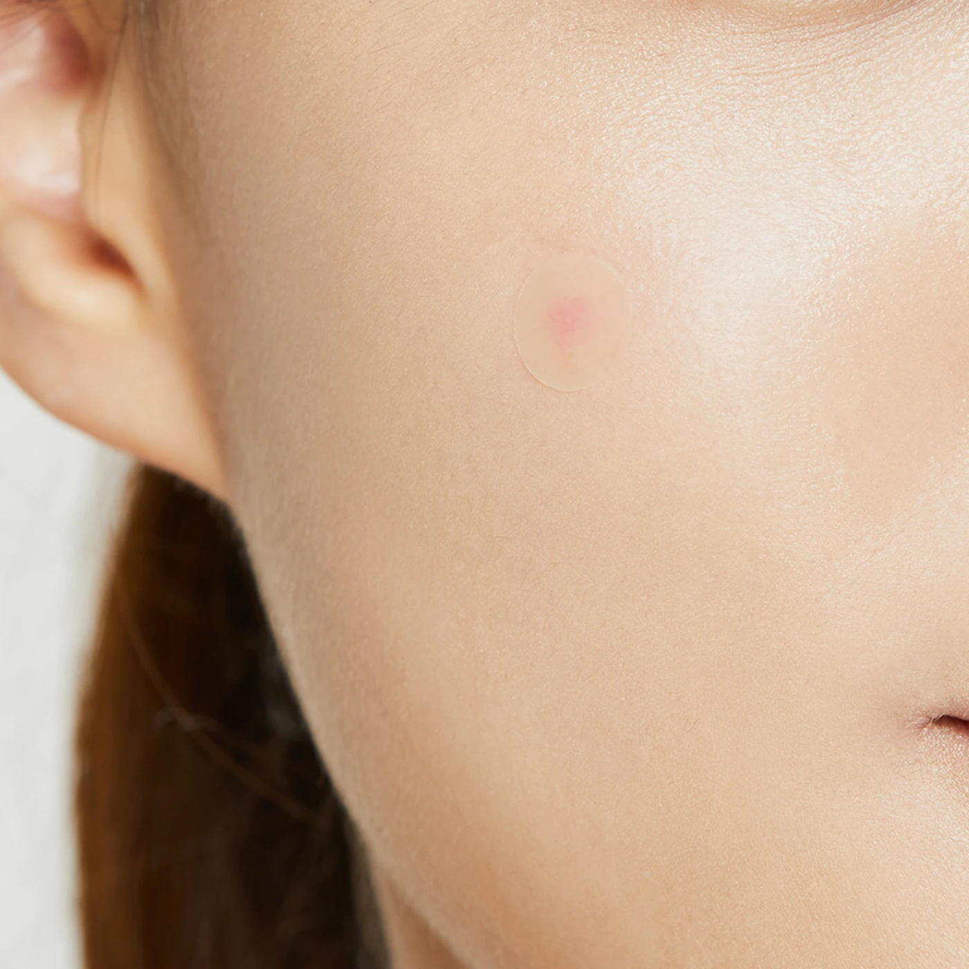 Ein Pickel, der mit einem Pimple Patch der Marke Coxrx bedeckt ist