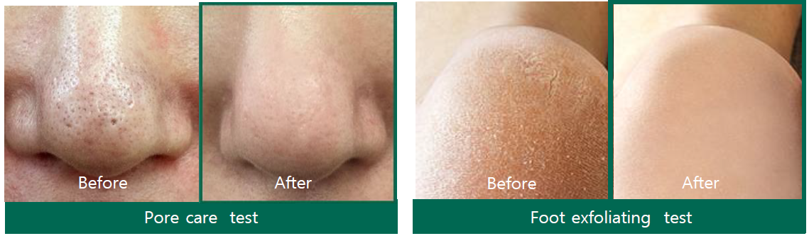 SBM-Cleansing-Bar-Test Some by mi Cleansing Bar Before and after